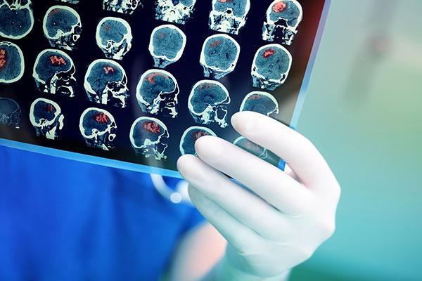 Brain Cancer